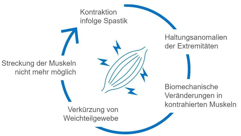 Information: Der Teufelskreis der Spastik